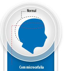 img sobre microcefalia ministerio