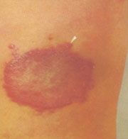 Hanseníase Tuberculóide mancha hanseniase tuberculoide